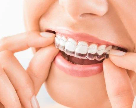 Clear Invisalign aligner being fitted over teeth
